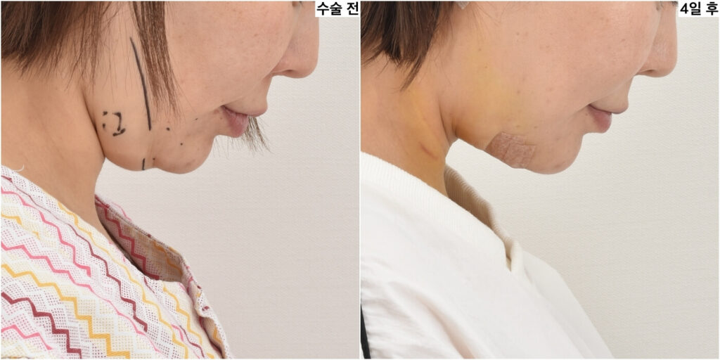 neck-lift-before-and-after
