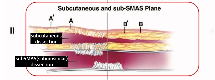 bi-lamellar-facelift