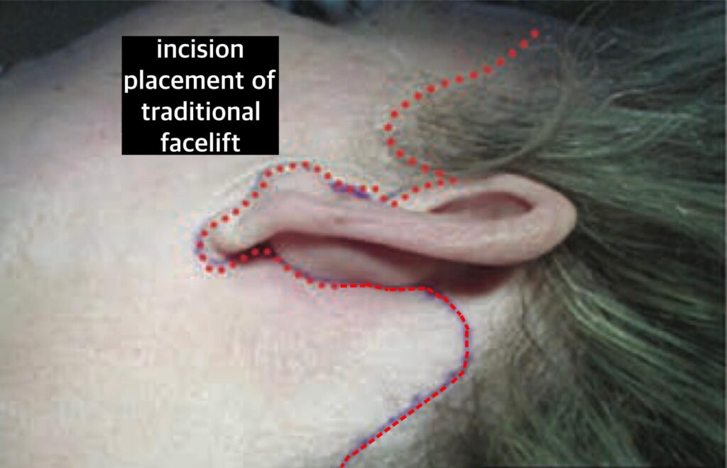 facelift-incision