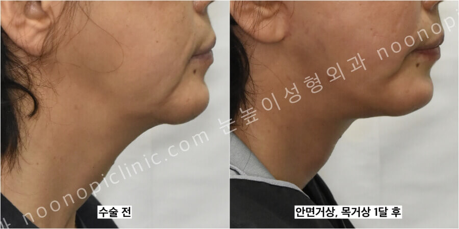 안면거상-목거상-전후모습