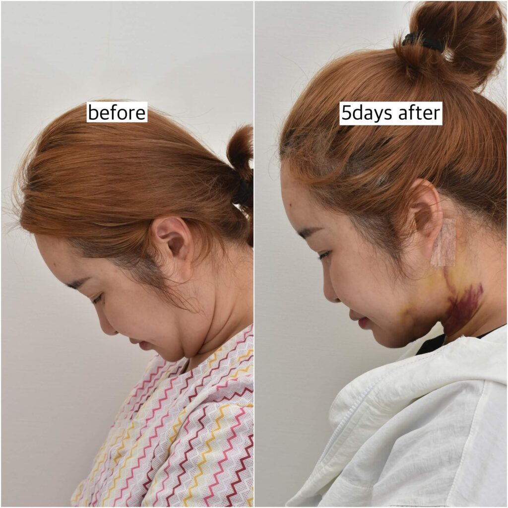 neck-lift-before-after
