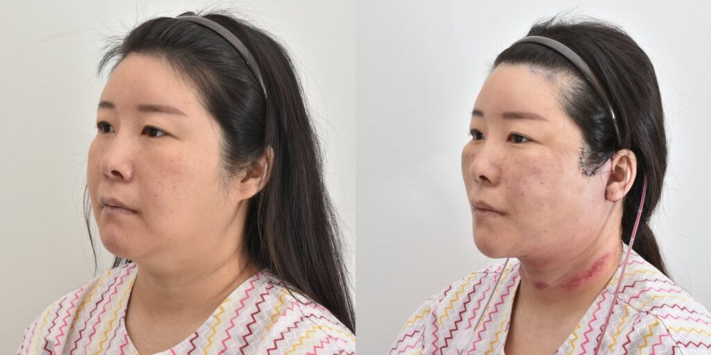 안면거상-전후모습