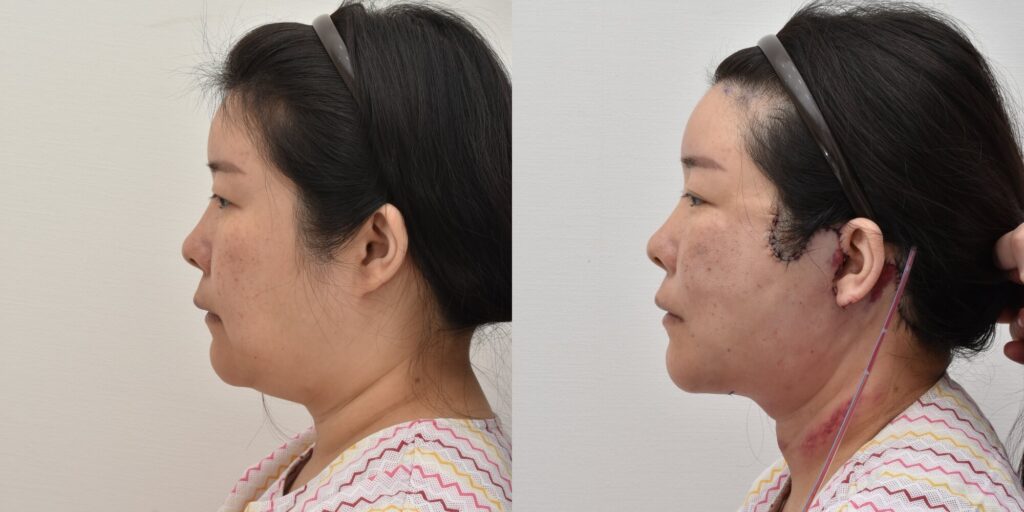 윤곽-후-볼처짐