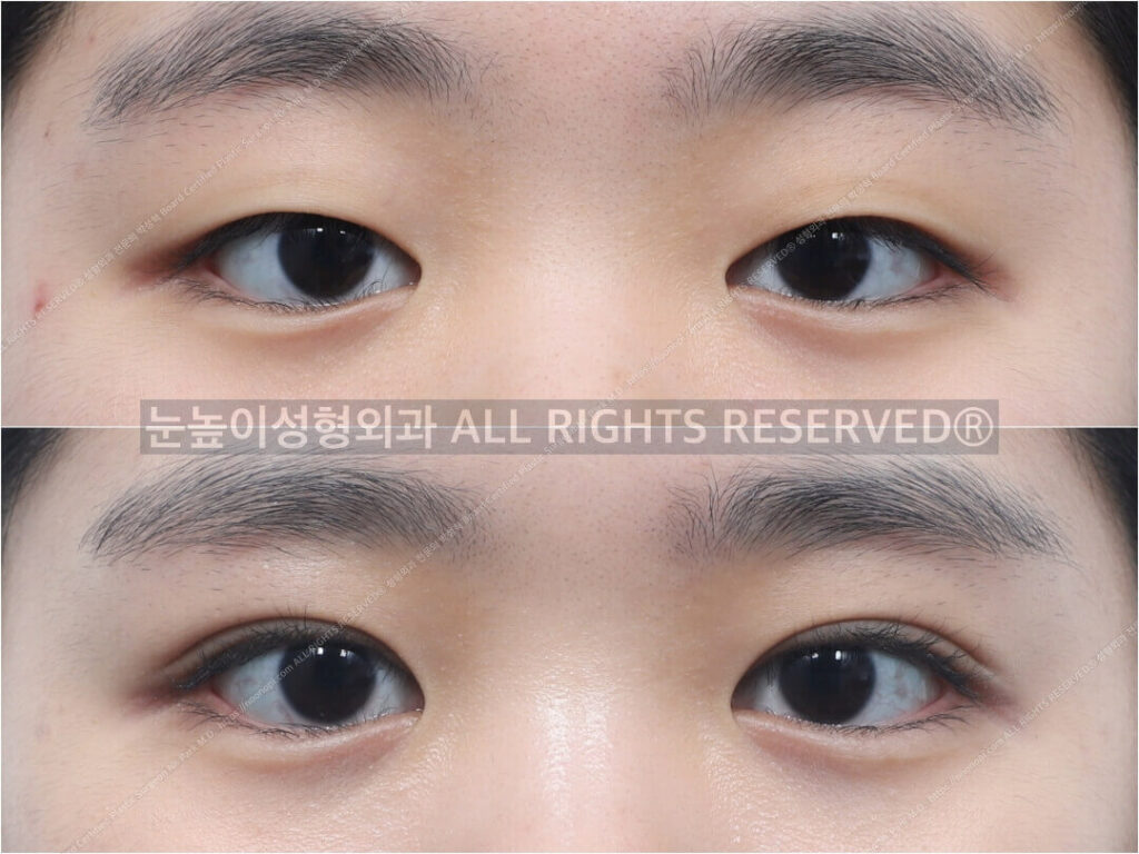 Asian-Double-Eyelid-Surgery