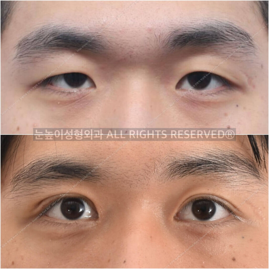 Double-Eyelid-Surgery-Consultation