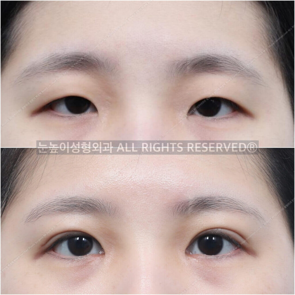 Eye-Aesthetics-Gangnam