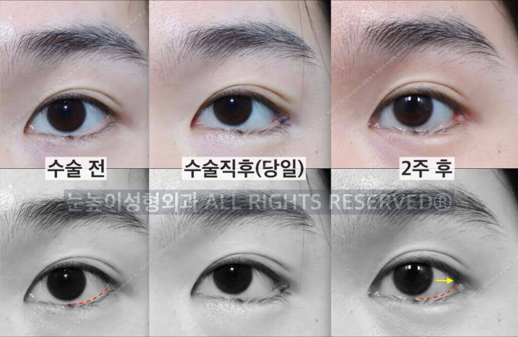 Hot’z-Canthoplasty