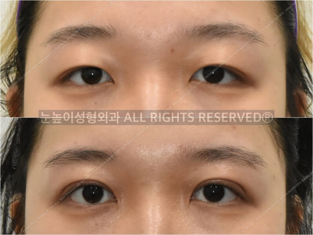 double-eyelid-fold