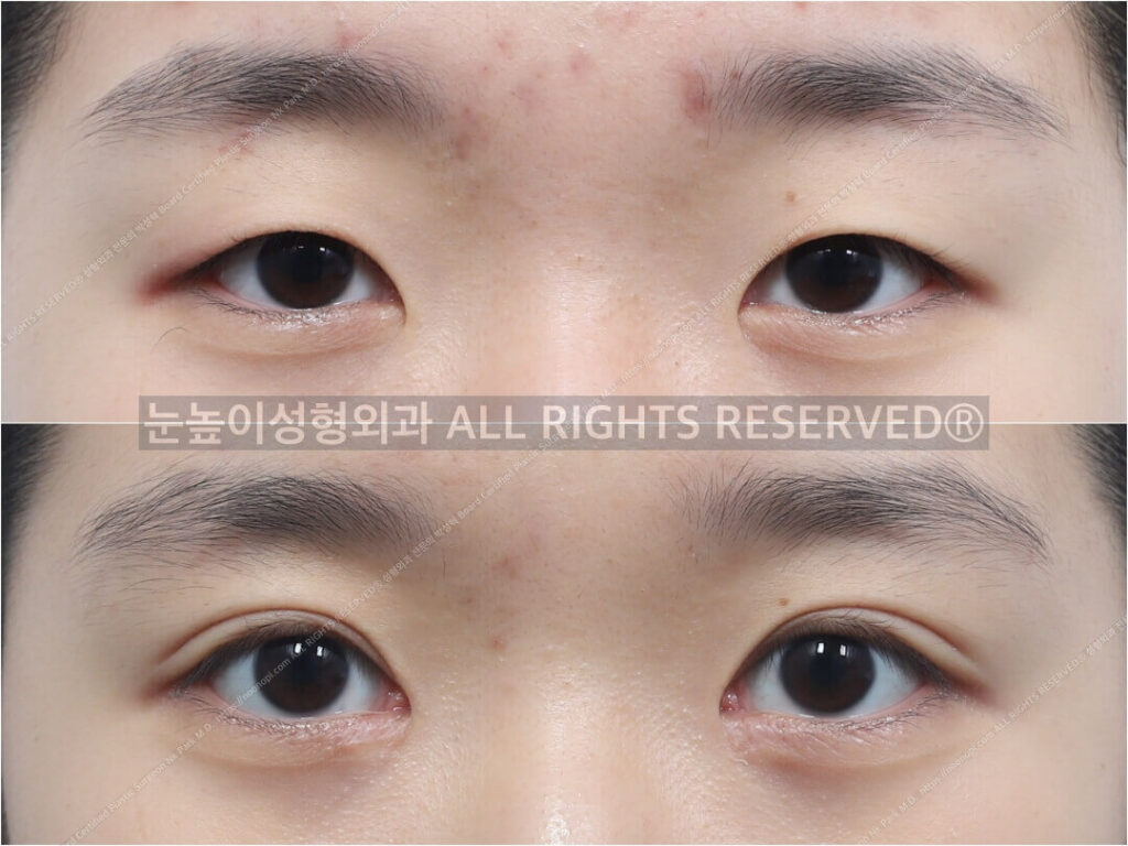 medial-epicanthoplasty