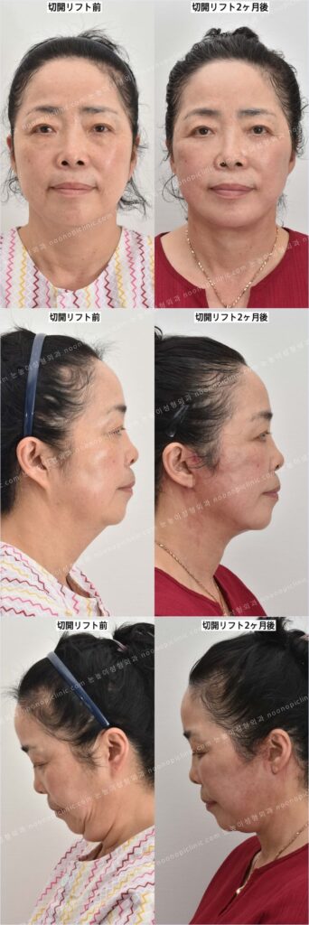 necklift-before-after