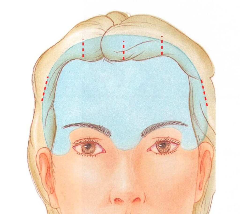 이마거상-절개-위치