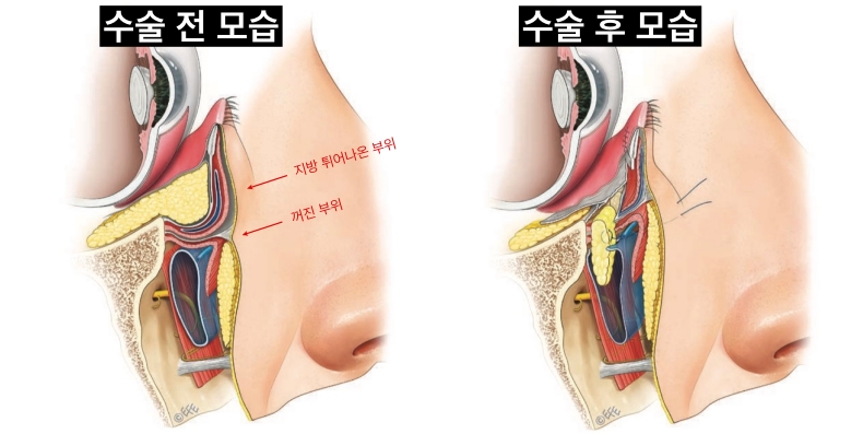 눈밑지방재배치