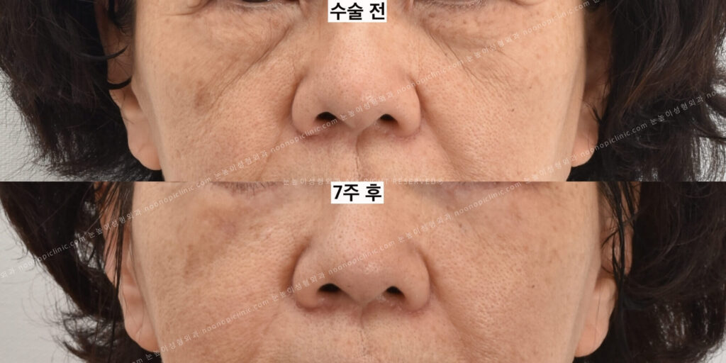 하안검-재수술-전후