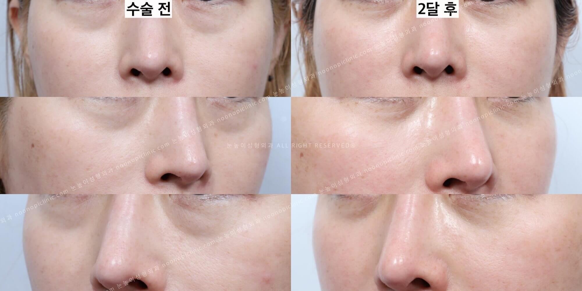 눈밑지방재배치