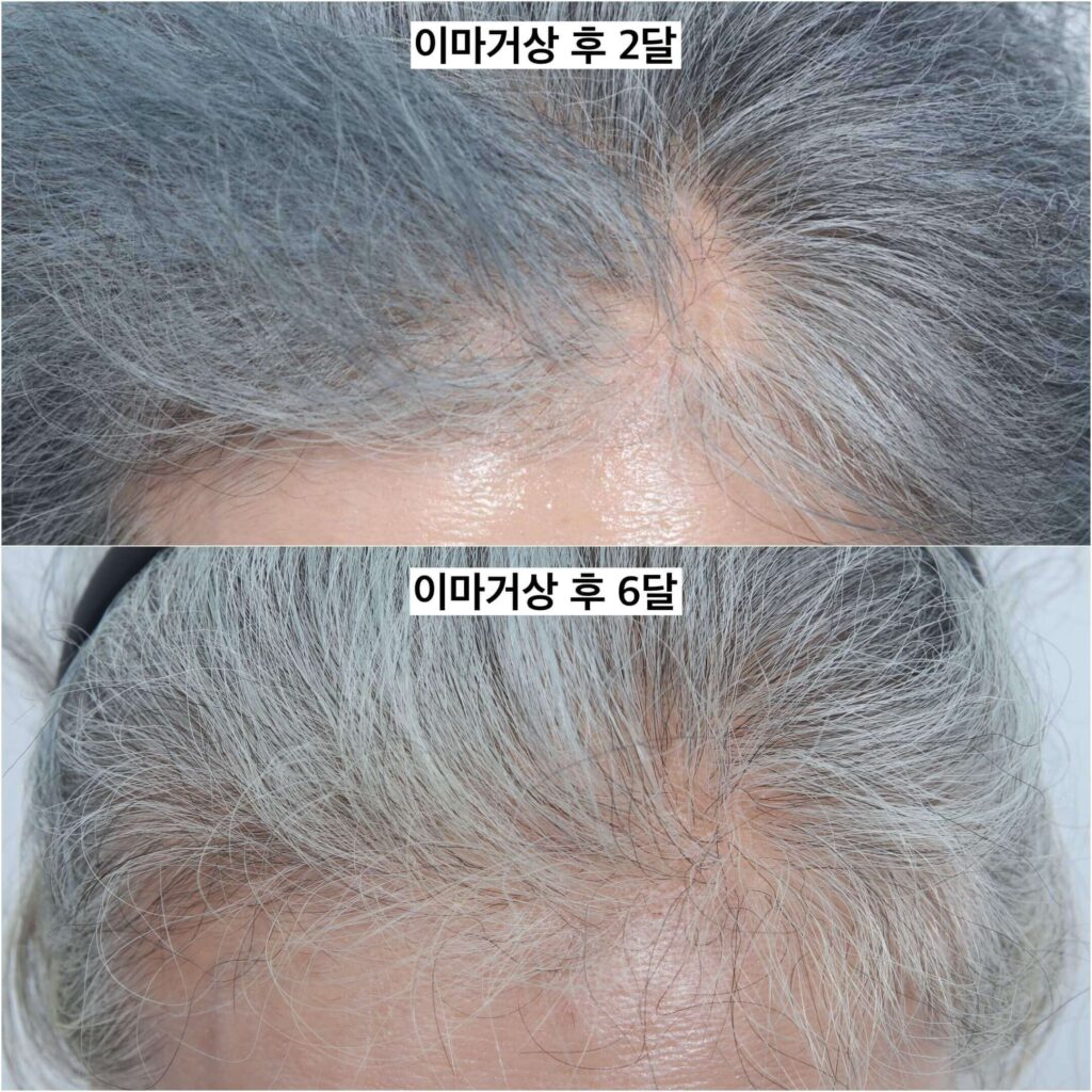 이마거상-탈모