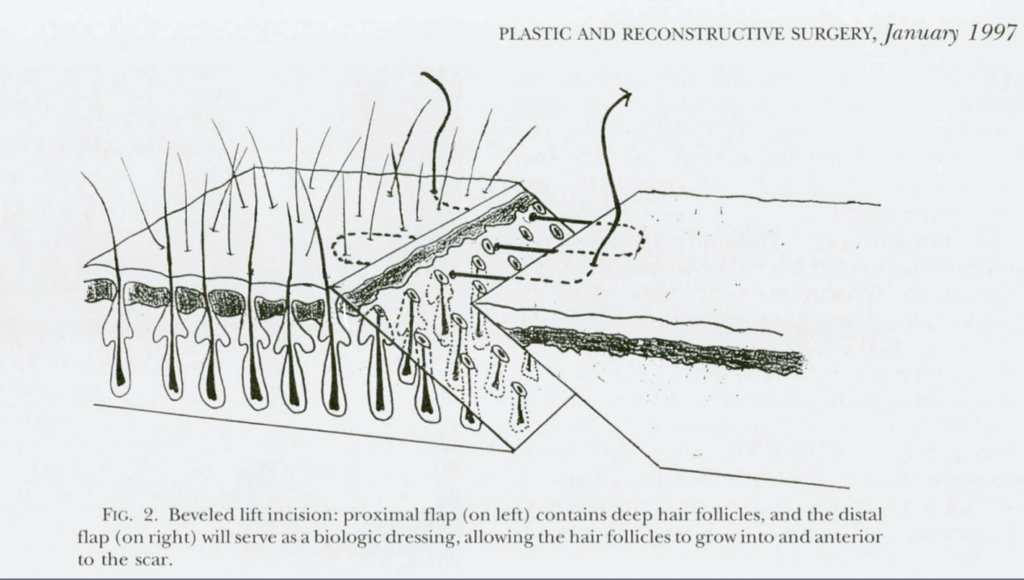 trichophytic-incision