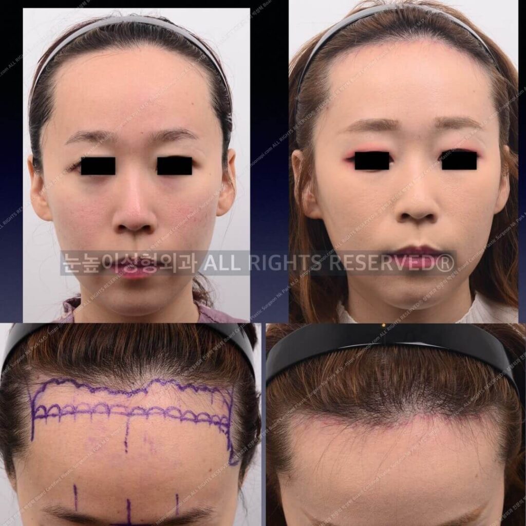 이마축소술-디자인