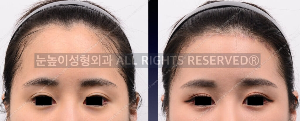 이마축소술-전후-모습