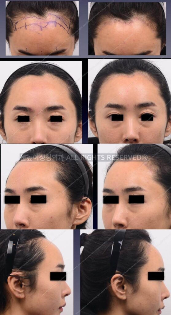 이마축소-후기