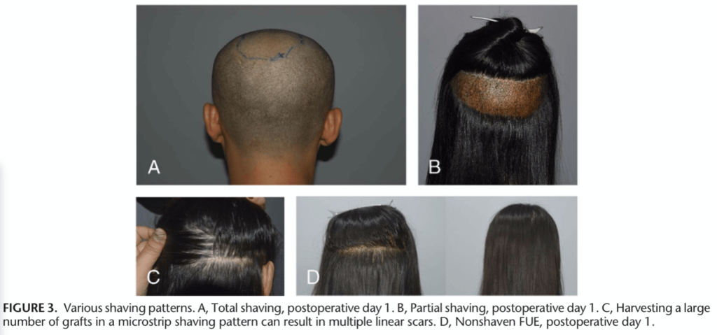 모발이식-비절개