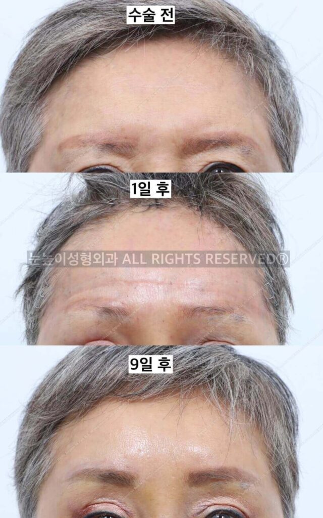 이마거상술붓기