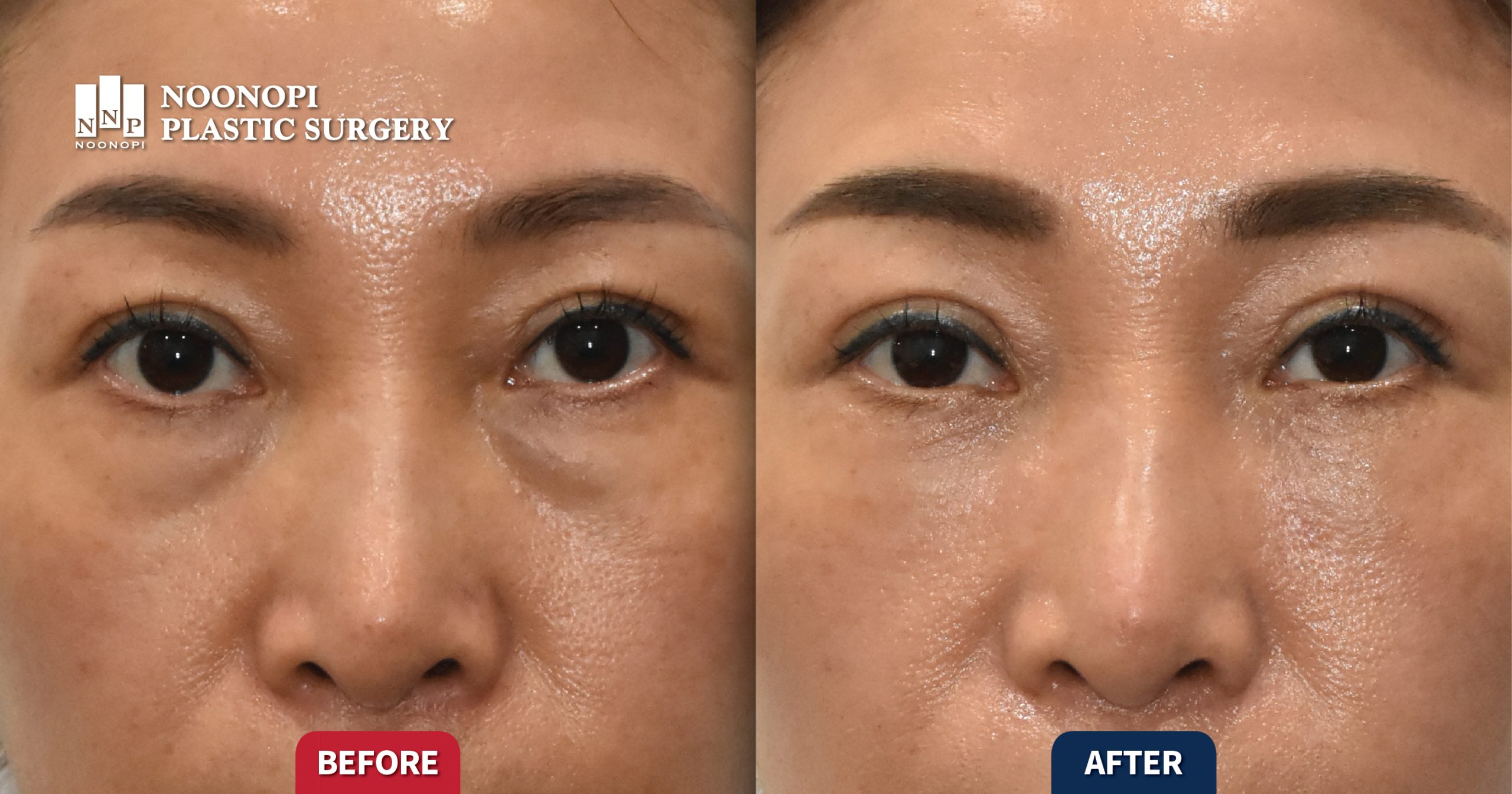 Works 눈밑지방재배치와 지방이식을 이용한 다크서클과 눈밑꺼짐 치료 001 scaled