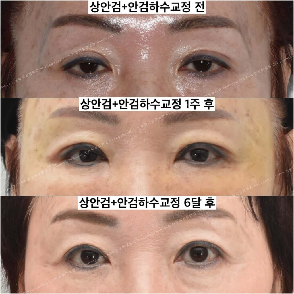 안검하수-후기
