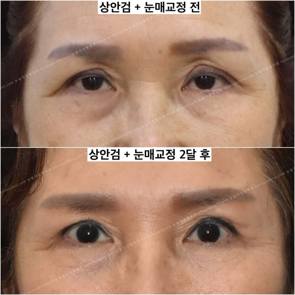 상안검-후기