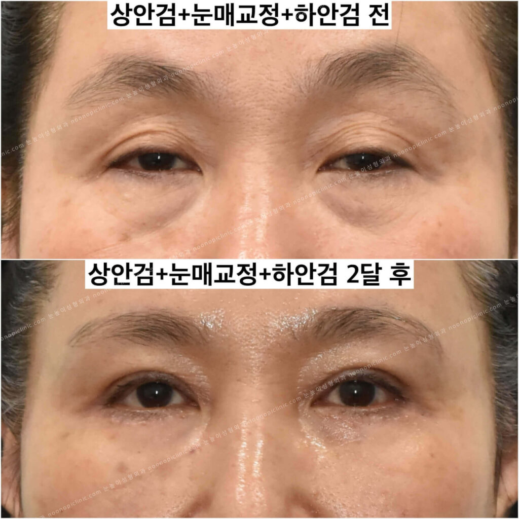 상하안검