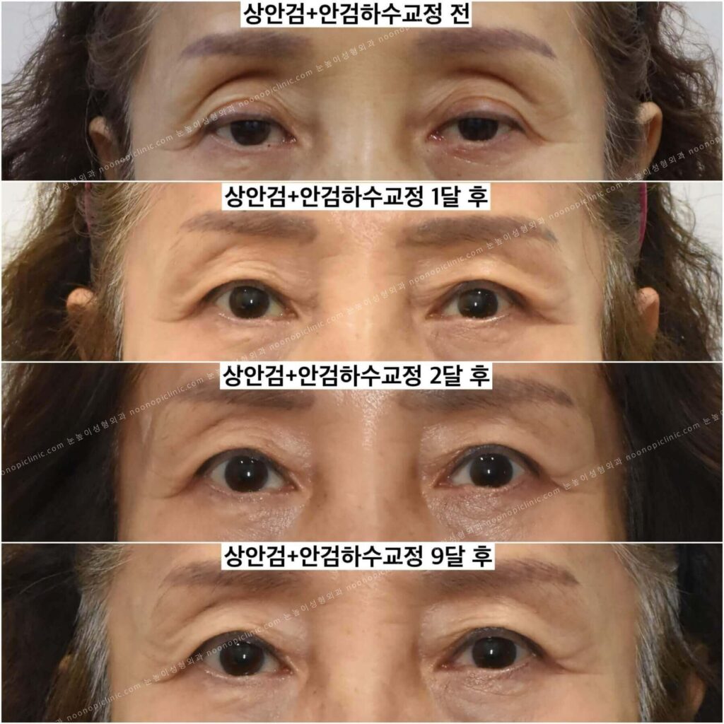 안검하수-후기