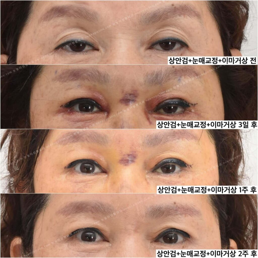 이마거상-안검하수