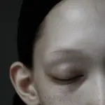 넓은 이마 치료법 이마축소술 vs 모발이식