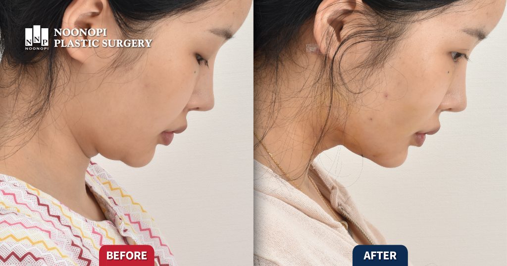 Works 목거상술 목주름과 이중턱의 교정 001