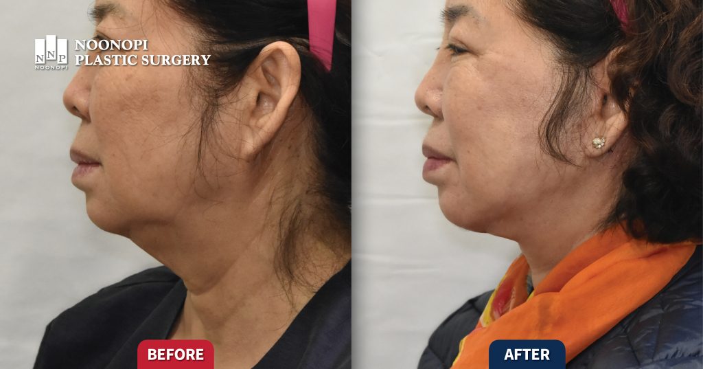 Works 목거상술 목주름과 이중턱의 교정 002