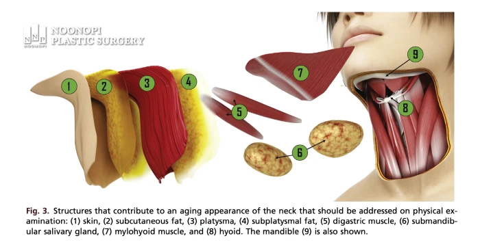 이중턱지방흡입 실패 원인 - 활경근과 목 해부학 구조