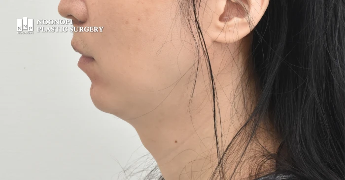 무턱과 목주름 처짐이 있는 40대 남성 목거상 전 모습