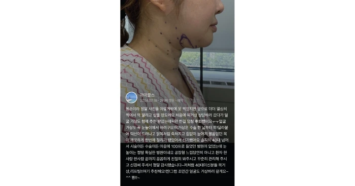 눈높이성형외과 미니목거상 후기