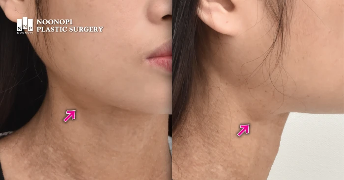 침샘비대로 인한 이중턱 사례